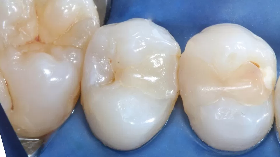 Восстановление зубов 4,5,6 эстетической реставрацией